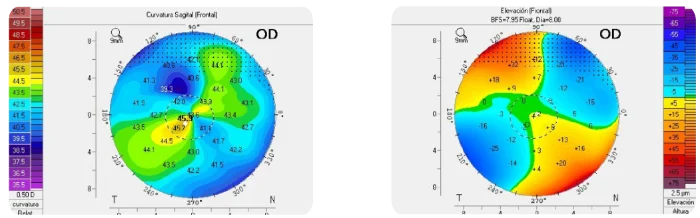 Dos mapas topográficos de la córnea: curvatura sagital y elevación, del ojo derecho